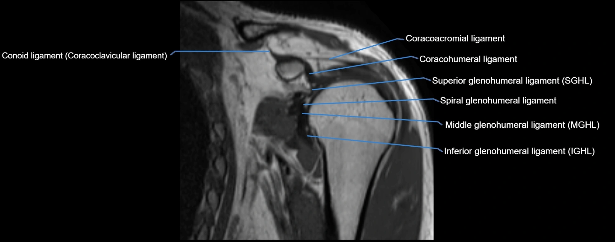 shoulder ligments coronal  cross sectional anatomy 3T MRI AI enhanced radiology image -img-00001-00016.webp